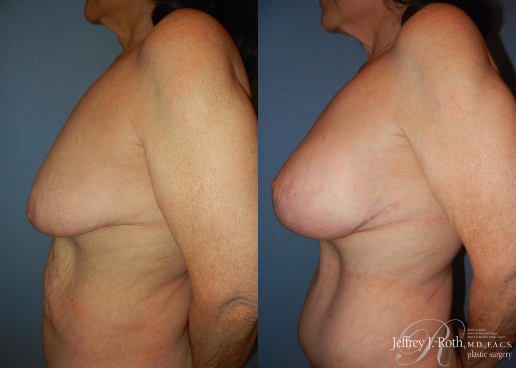 Before & After Breast Lift With Implants Case 64 View #3 View in Las Vegas, NV