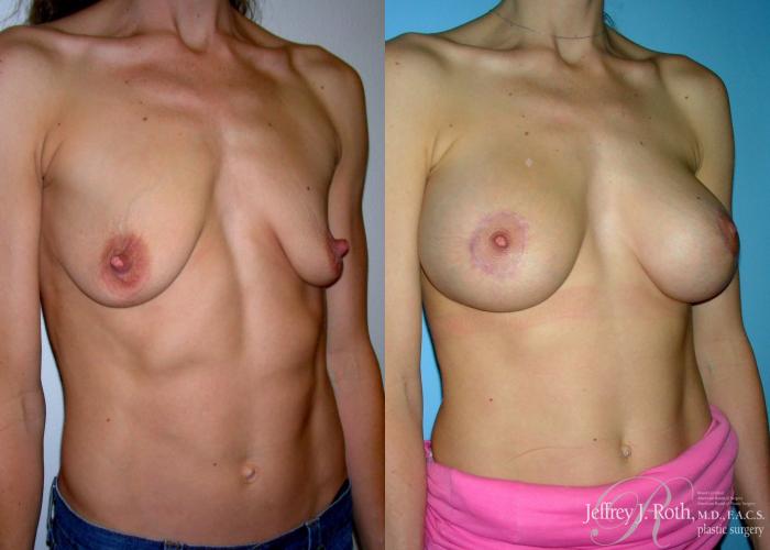 Before & After Breast Lift With Implants Case 65 View #2 View in Las Vegas, NV