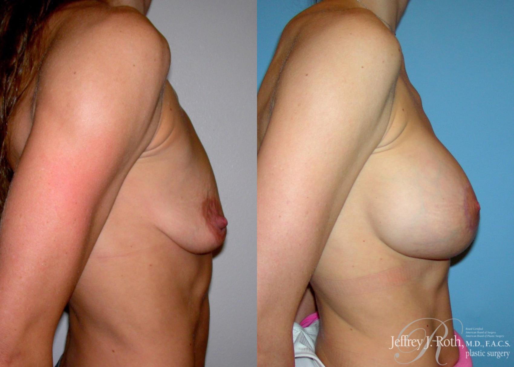 Before & After Breast Lift With Implants Case 65 View #3 View in Las Vegas, NV
