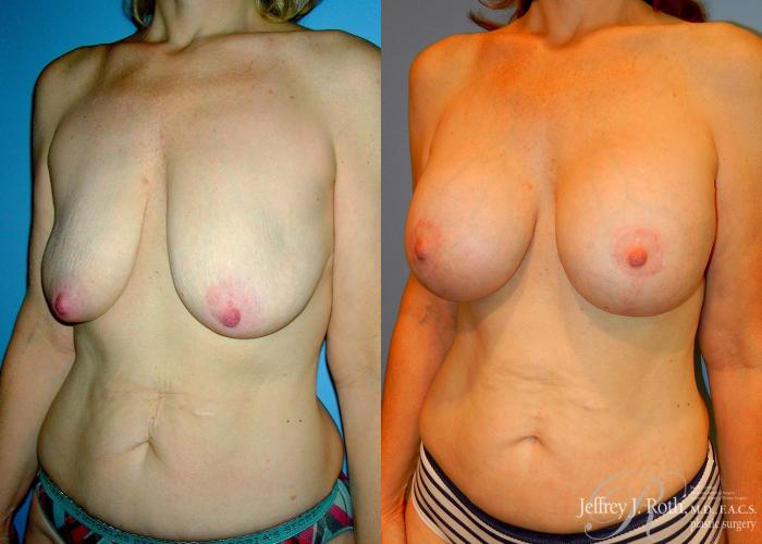 Before & After Breast Lift With Implants Case 66 View #2 View in Las Vegas, NV