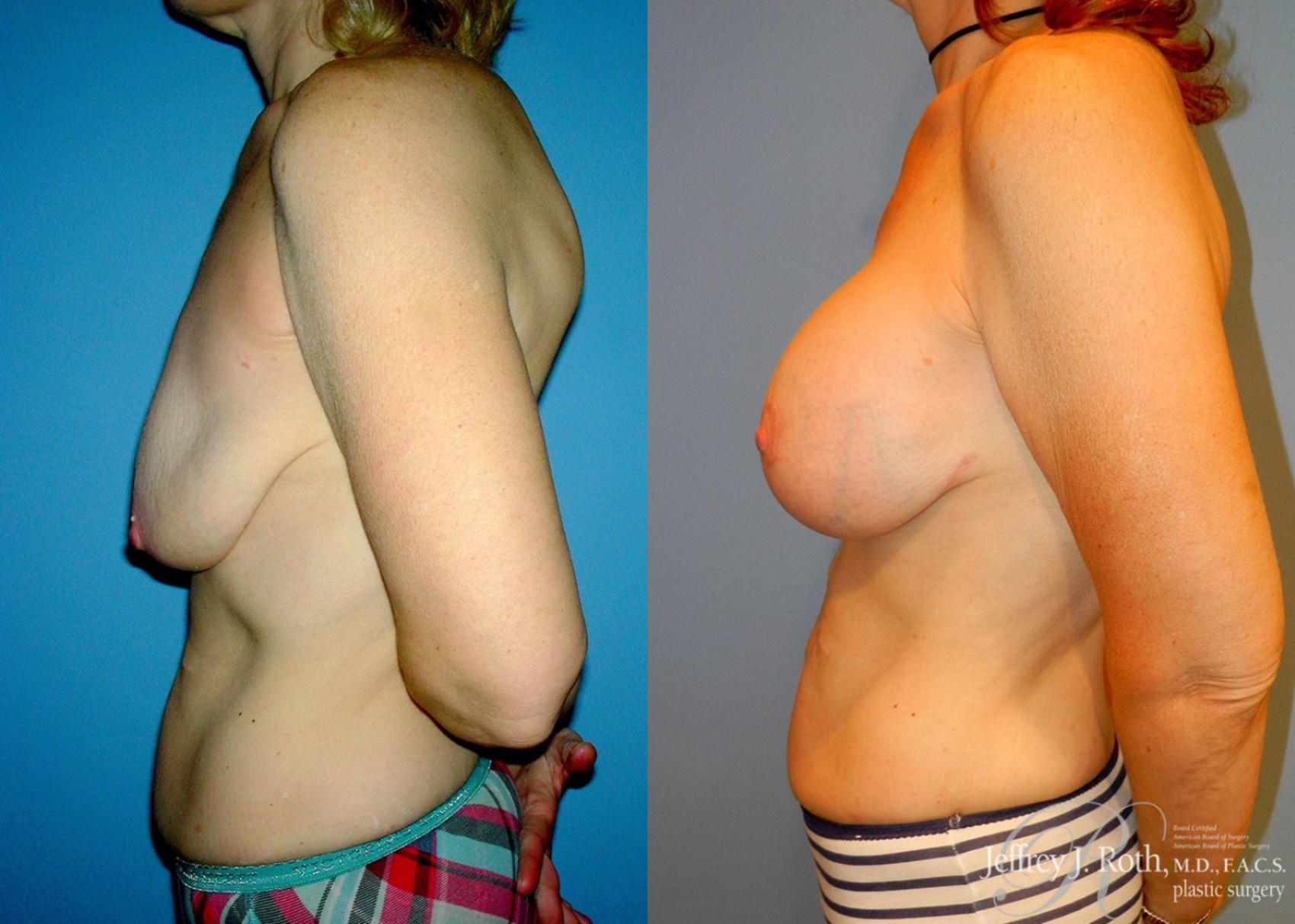 Before & After Breast Lift With Implants Case 66 View #3 View in Las Vegas, NV