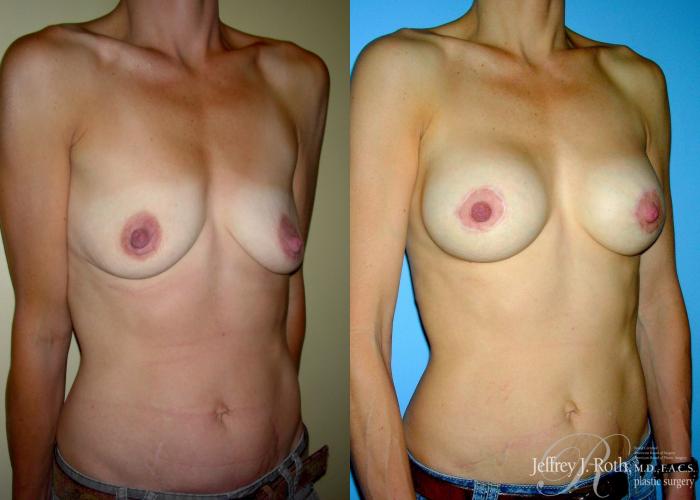 Before & After Breast Lift With Implants Case 67 View #2 View in Las Vegas and Henderson, NV