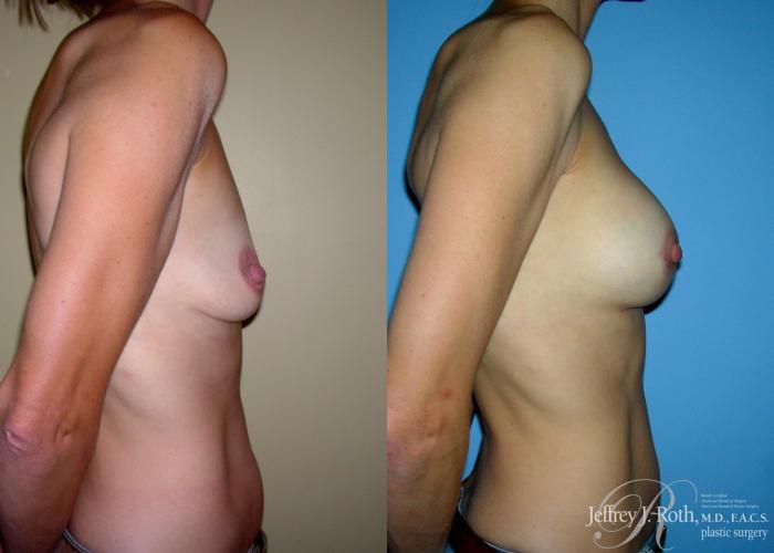 Before & After Breast Lift With Implants Case 67 View #3 View in Las Vegas and Henderson, NV