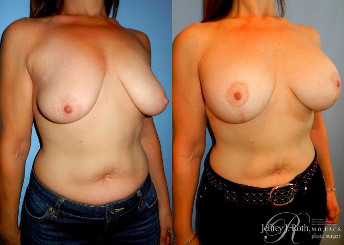 Before & After Breast Lift With Implants Case 68 View #2 View in Las Vegas, NV