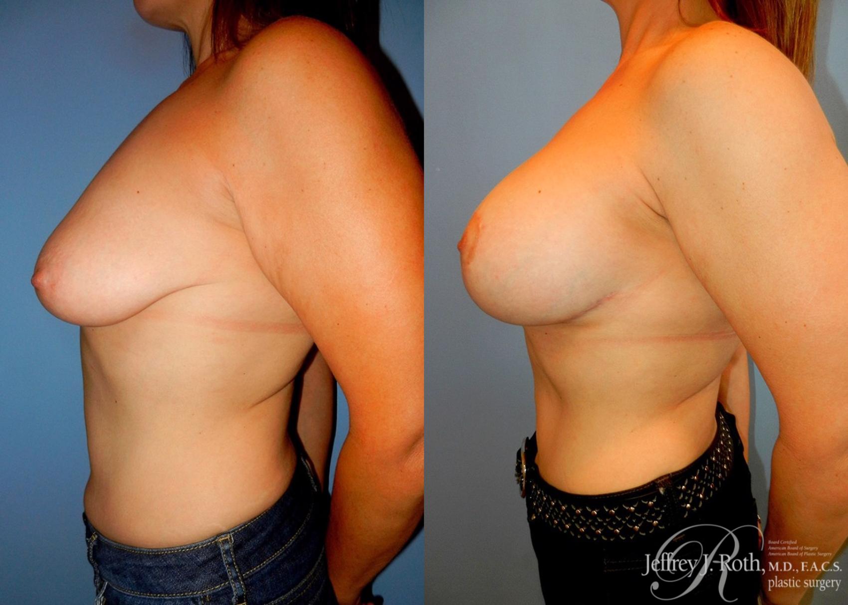 Before & After Breast Lift With Implants Case 68 View #3 View in Las Vegas, NV