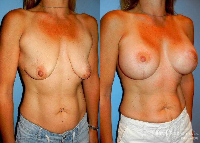 Before & After Breast Lift With Implants Case 69 View #2 View in Las Vegas, NV