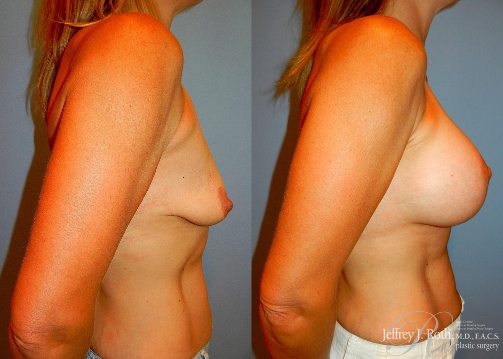 Before & After Breast Lift With Implants Case 69 View #3 View in Las Vegas, NV