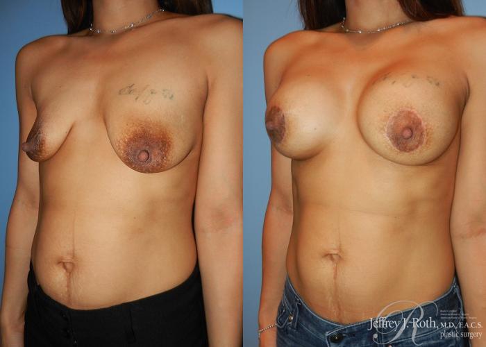 Before & After Breast Lift With Implants Case 71 View #2 View in Las Vegas, NV