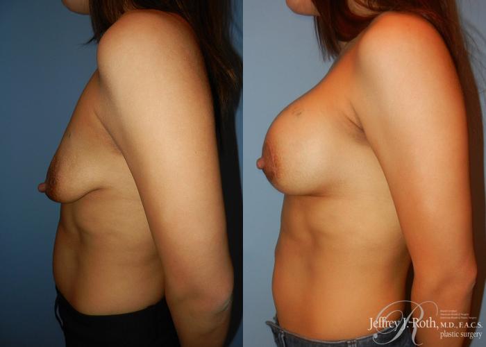 Before & After Breast Lift With Implants Case 71 View #3 View in Las Vegas, NV