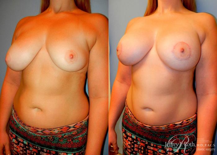 Before & After Breast Lift With Implants Case 72 View #2 View in Las Vegas, NV
