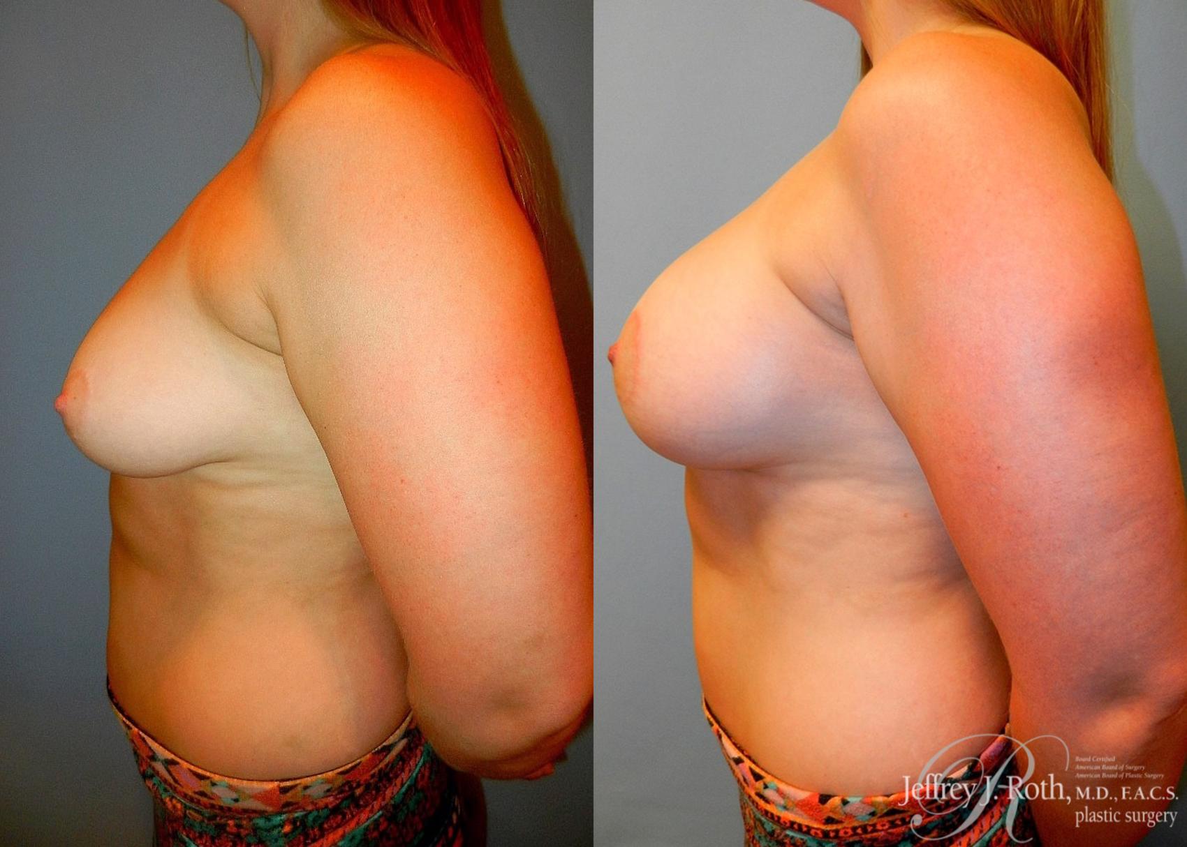 Before & After Breast Lift With Implants Case 72 View #3 View in Las Vegas, NV