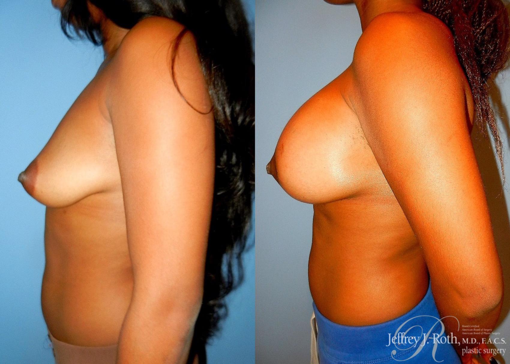 Before & After Breast Lift With Implants Case 73 View #3 View in Las Vegas, NV