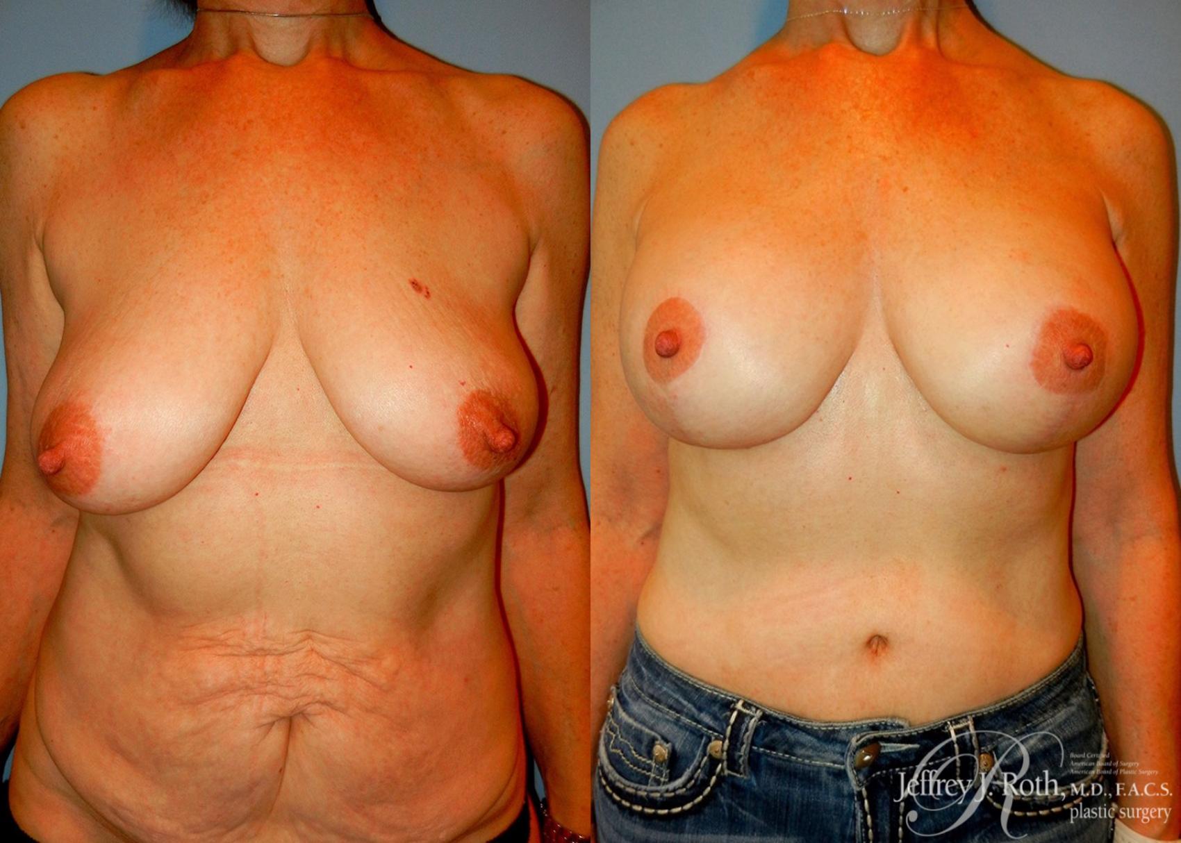 Before & After Breast Lift With Implants Case 74 View #1 View in Las Vegas, NV