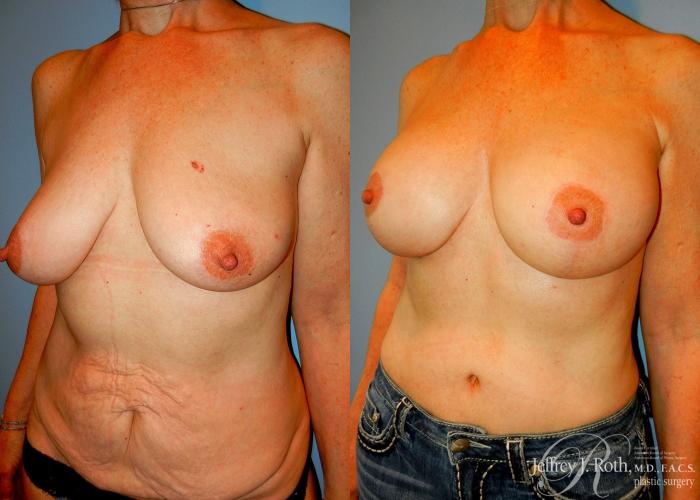 Before & After Breast Lift With Implants Case 74 View #2 View in Las Vegas and Henderson, NV