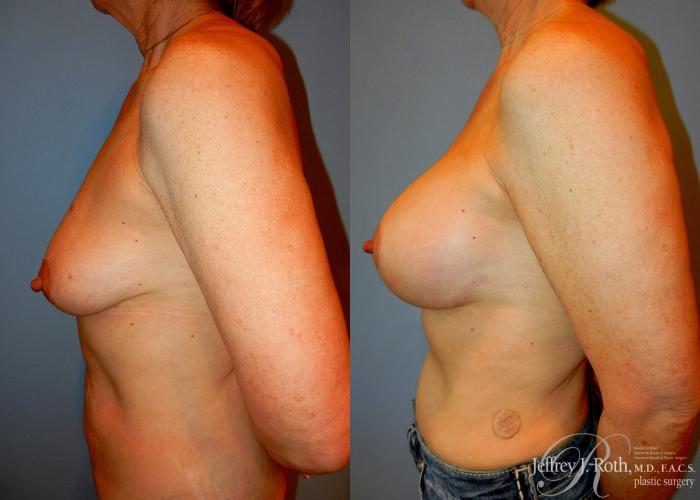 Before & After Breast Lift With Implants Case 74 View #3 View in Las Vegas and Henderson, NV