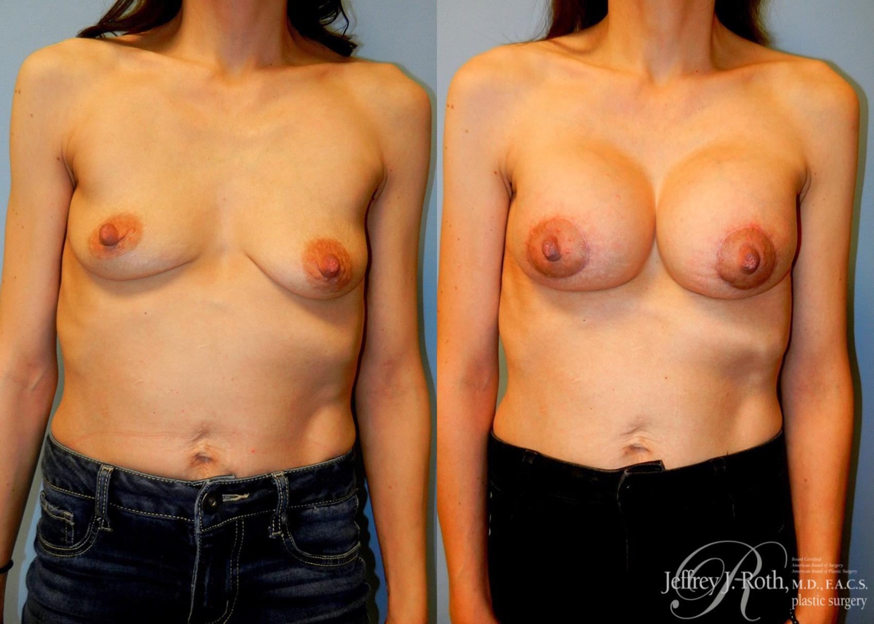 Before & After Breast Lift With Implants Case 75 View #1 View in Las Vegas, NV