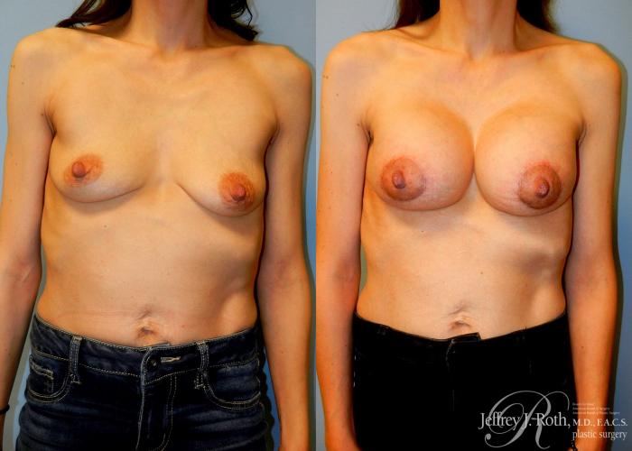 Before & After Breast Lift With Implants Case 75 View #1 View in Las Vegas and Henderson, NV