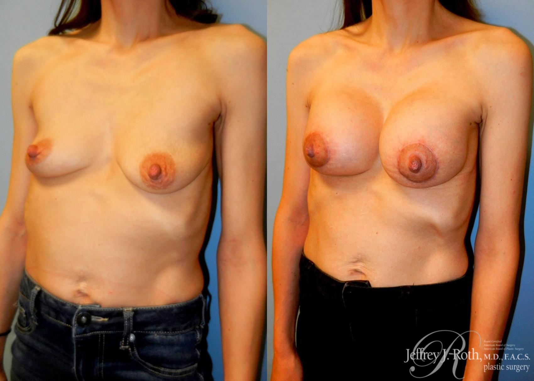 Before & After Breast Lift With Implants Case 75 View #2 View in Las Vegas, NV