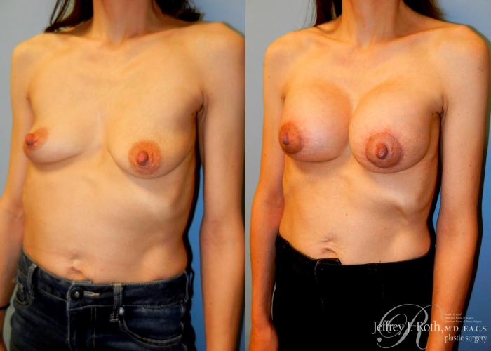 Before & After Breast Lift With Implants Case 75 View #2 View in Las Vegas and Henderson, NV