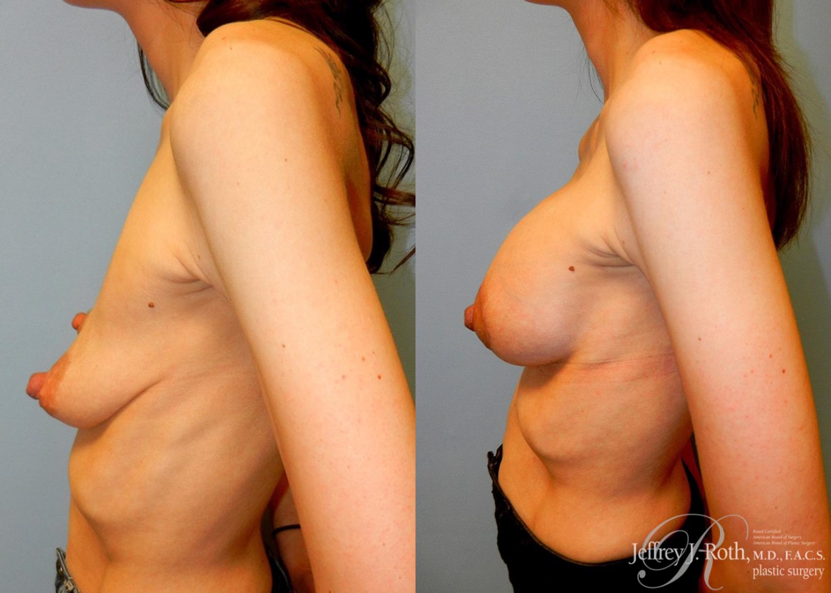 Before & After Breast Lift With Implants Case 75 View #3 View in Las Vegas, NV