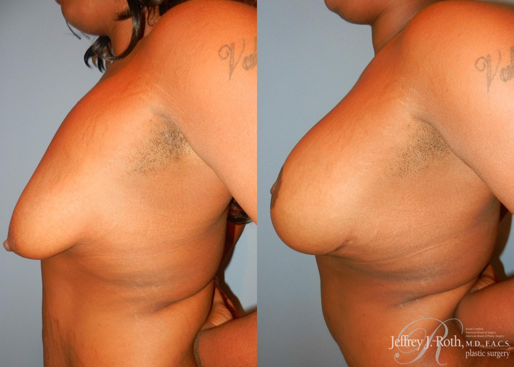 Before & After Breast Lift With Implants Case 76 View #3 View in Las Vegas, NV