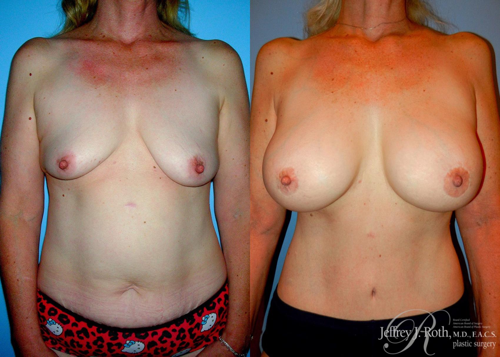 Before & After Breast Lift With Implants Case 77 View #1 View in Las Vegas, NV