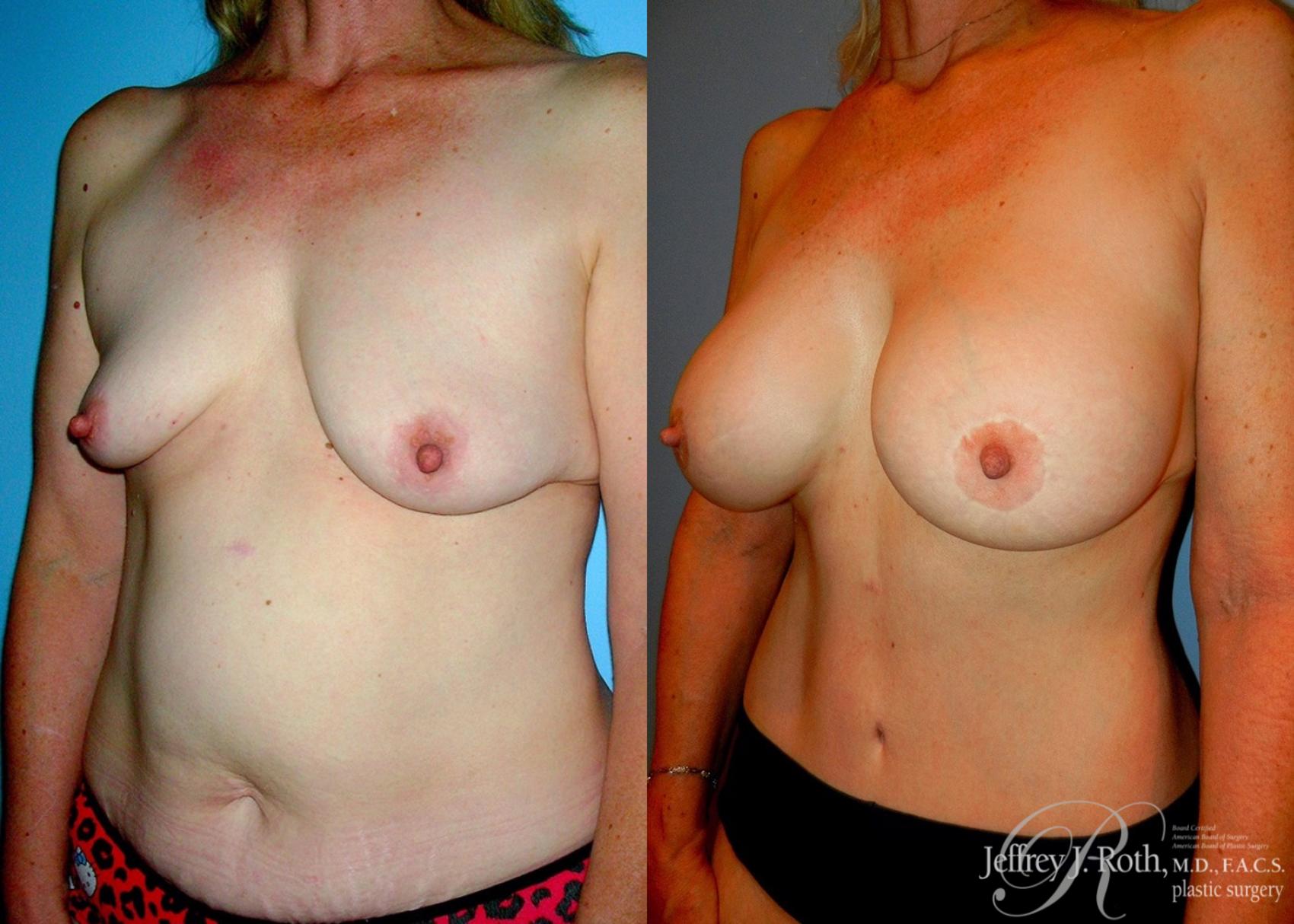 Before & After Breast Lift With Implants Case 77 View #2 View in Las Vegas, NV