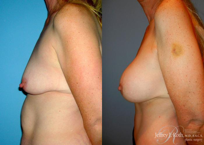 Before & After Breast Lift With Implants Case 77 View #3 View in Las Vegas, NV
