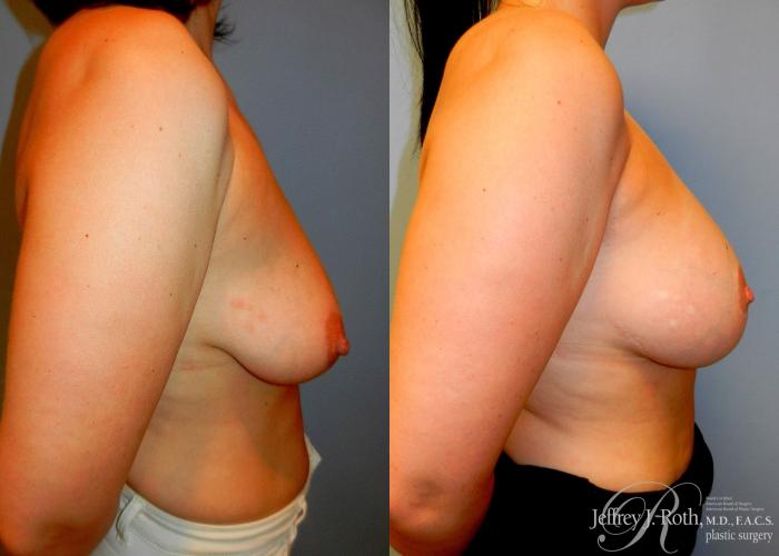 Before & After Breast Lift With Implants Case 78 View #3 View in Las Vegas, NV