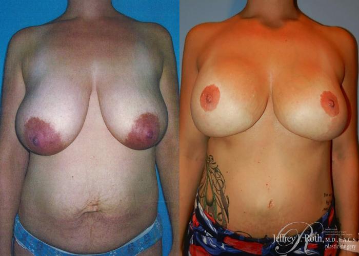 Before & After Breast Lift With Implants Case 79 View #1 View in Las Vegas and Henderson, NV