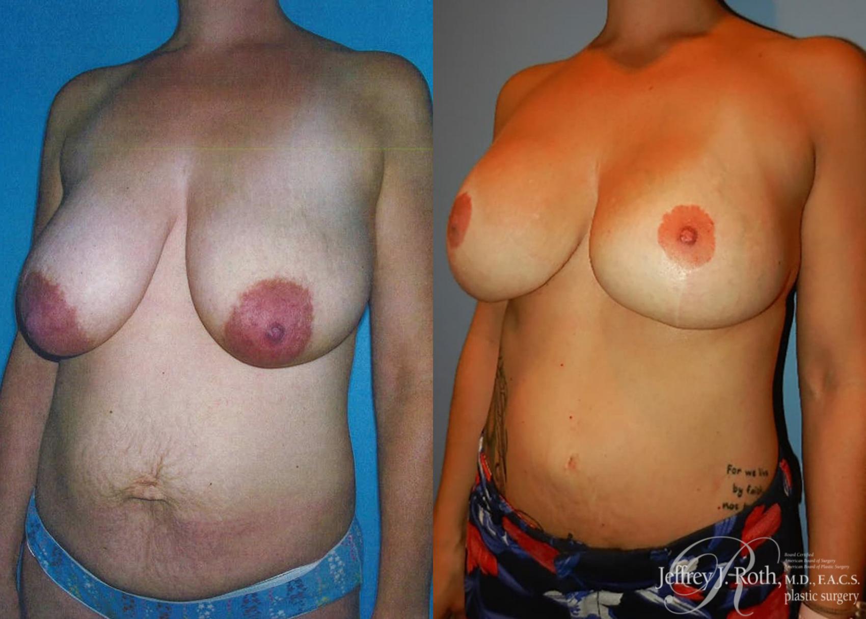 Before & After Breast Lift With Implants Case 79 View #2 View in Las Vegas, NV