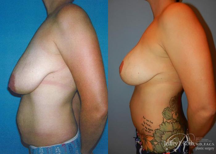 Before & After Breast Lift With Implants Case 79 View #3 View in Las Vegas and Henderson, NV