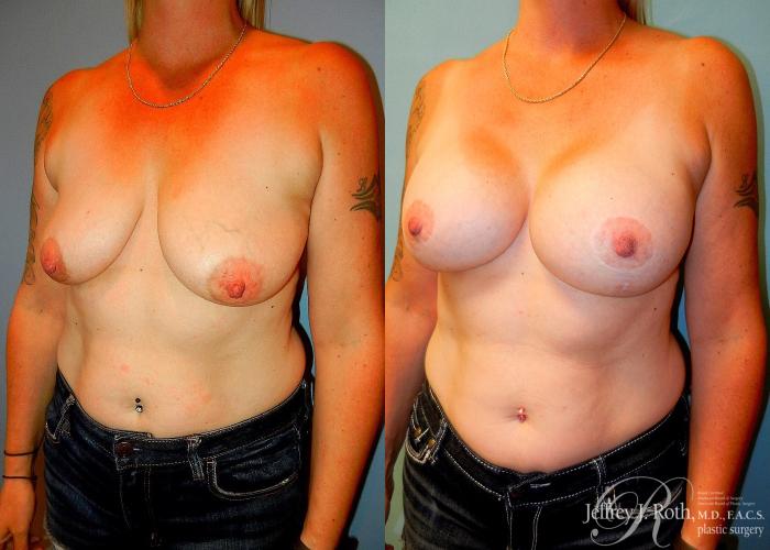 Before & After Breast Lift With Implants Case 80 View #2 View in Las Vegas and Henderson, NV