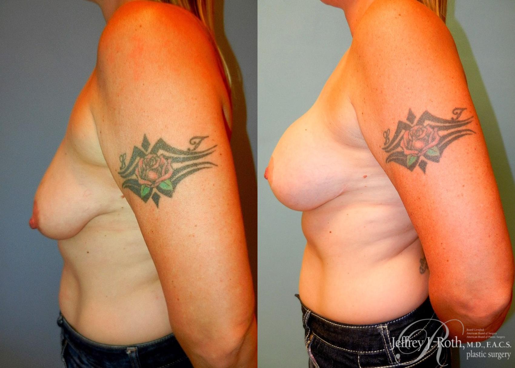 Before & After Breast Lift With Implants Case 80 View #3 View in Las Vegas, NV