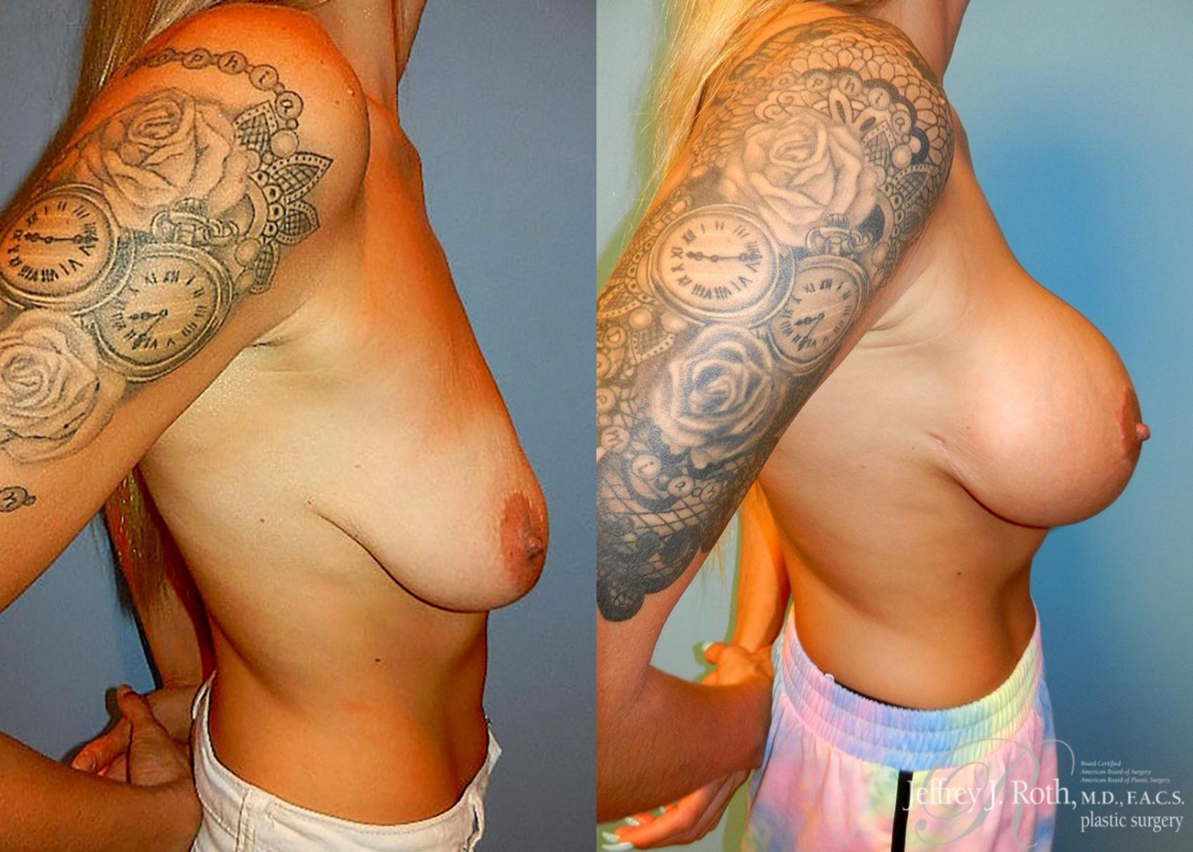 Before & After Breast Lift With Implants Case 81 View #3 View in Las Vegas, NV