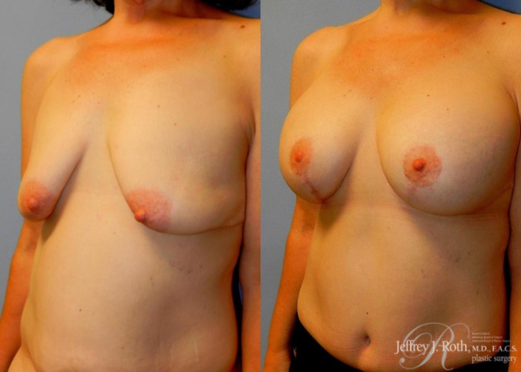 Before & After Breast Lift With Implants Case 82 View #2 View in Las Vegas, NV