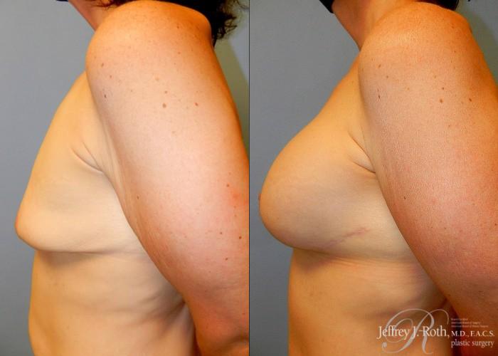 Before & After Breast Lift With Implants Case 82 View #3 View in Las Vegas, NV