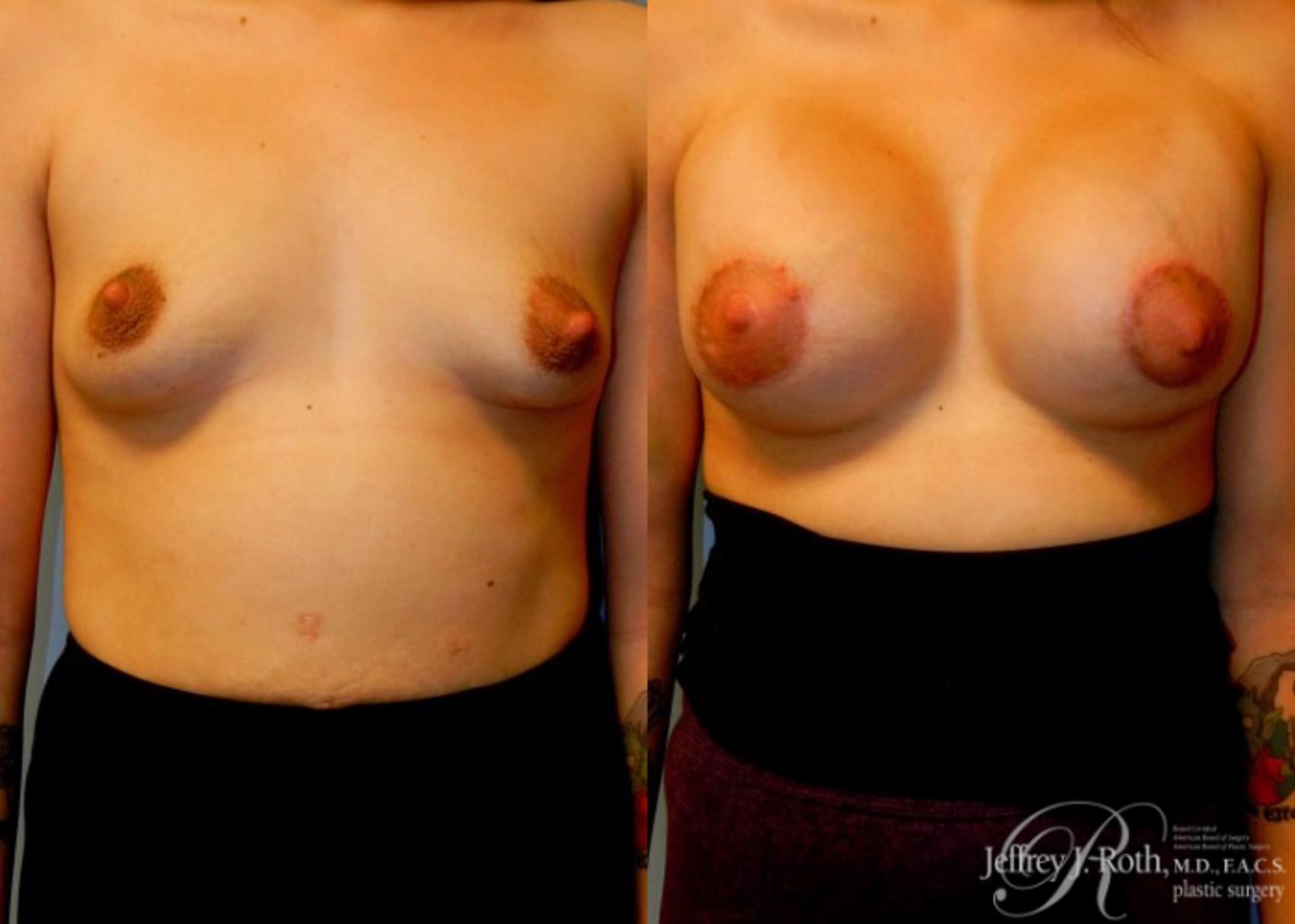 Before & After Breast Lift With Implants Case 83 View #1 View in Las Vegas, NV
