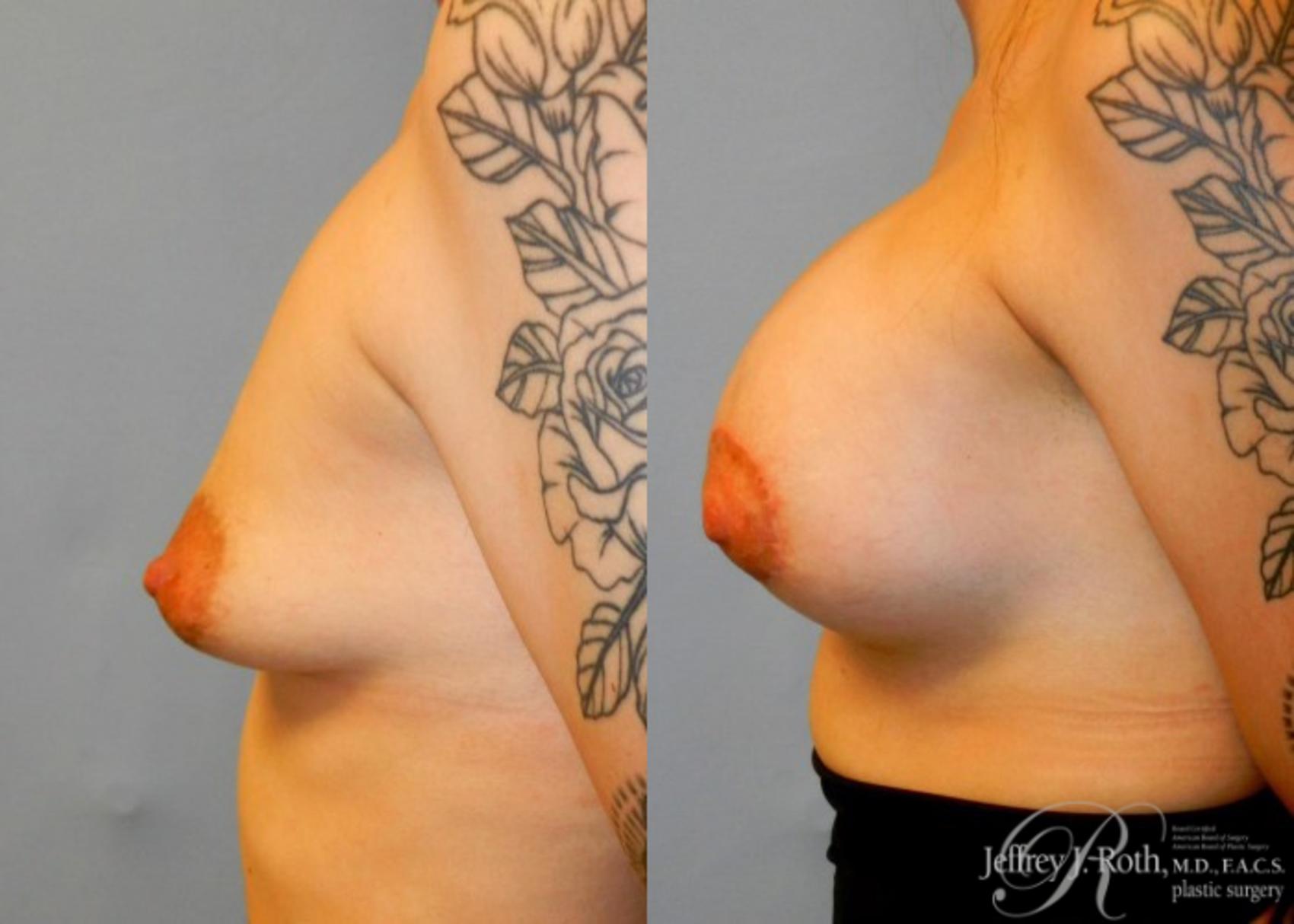Before & After Breast Lift With Implants Case 83 View #3 View in Las Vegas, NV