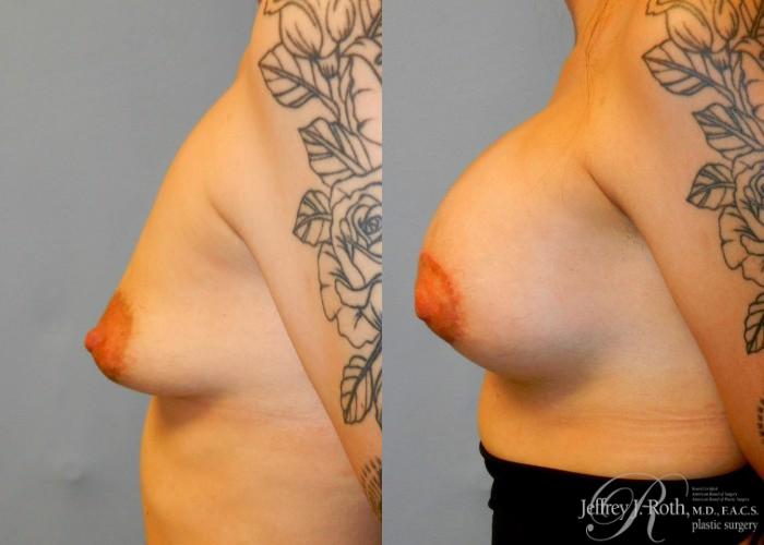 Before & After Breast Lift With Implants Case 83 View #3 View in Las Vegas and Henderson, NV