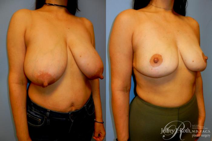 Before & After Breast Reduction Case 217 Right Oblique View in Las Vegas, NV