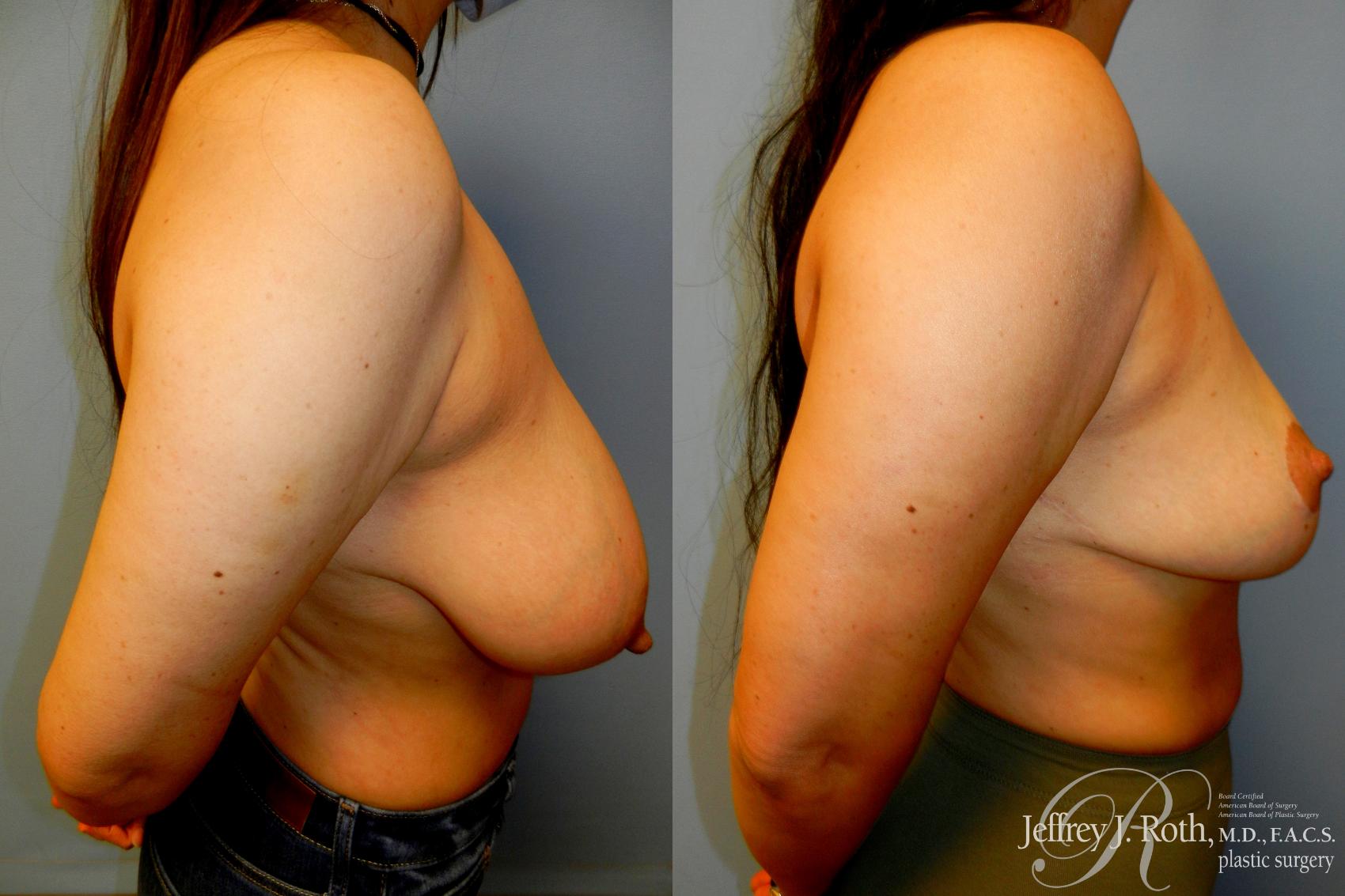 Before & After Breast Reduction Case 217 Right Side View in Las Vegas, NV