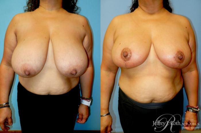 Before & After Breast Reduction Case 298 Front View in Las Vegas and Henderson, NV