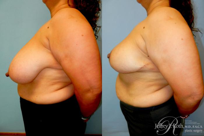 Before & After Breast Reduction Case 298 Left Side View in Las Vegas and Henderson, NV