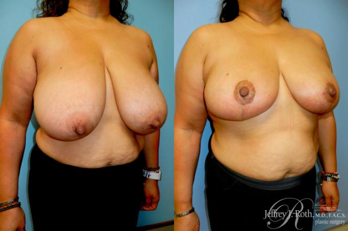 Before & After Breast Reduction Case 298 Right Oblique View in Las Vegas and Henderson, NV