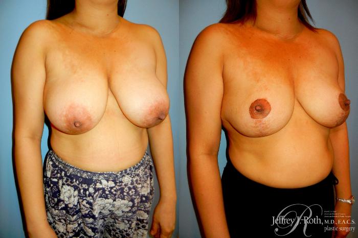 Before & After Breast Reduction Case 323 Right Oblique View in Las Vegas and Henderson, NV