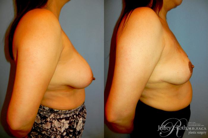 Before & After Breast Reduction Case 323 Right Side View in Las Vegas and Henderson, NV