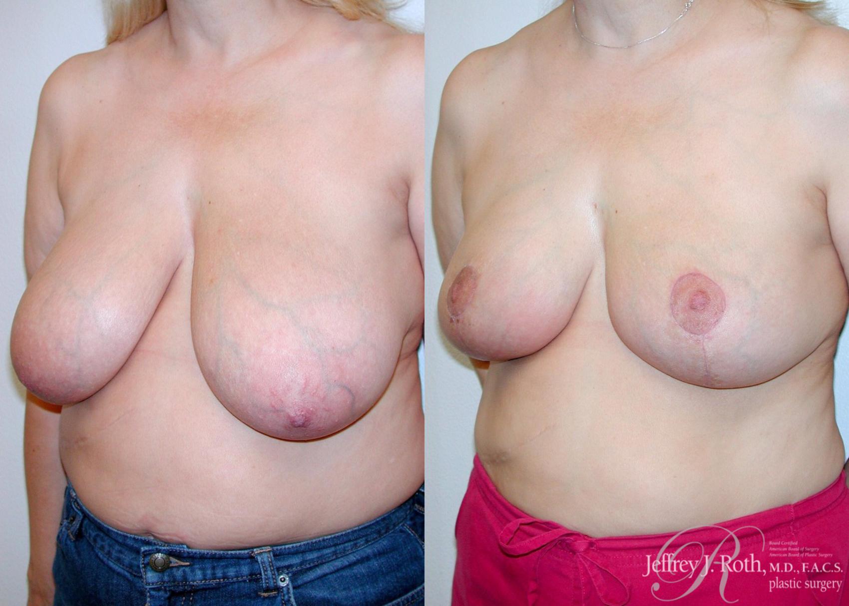 Before & After Breast Reduction Case 84 View #2 View in Las Vegas, NV