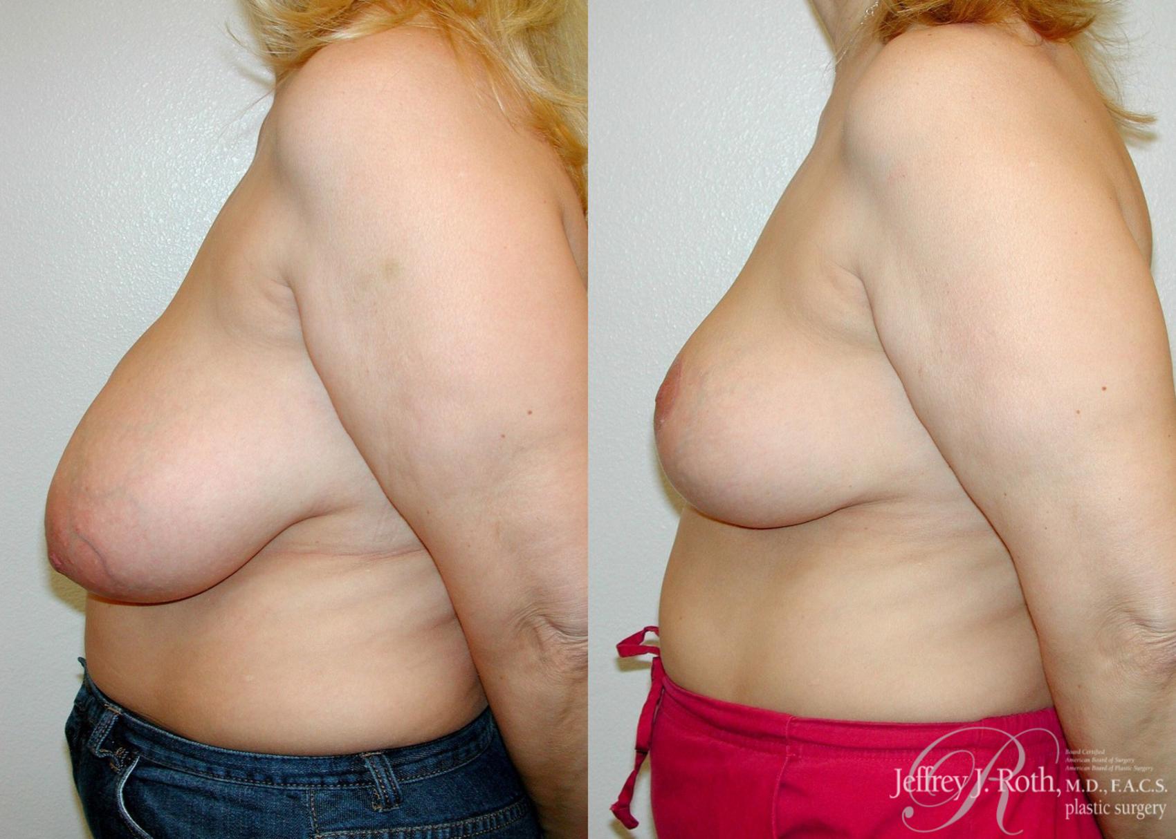 Before & After Breast Reduction Case 84 View #3 View in Las Vegas, NV