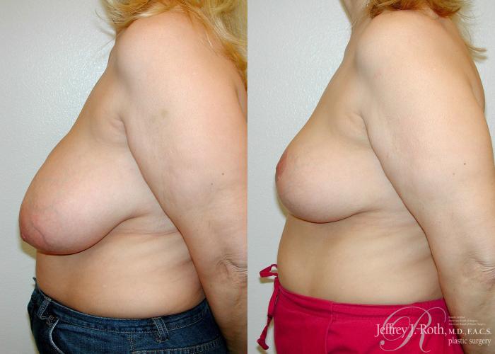 Before & After Breast Reduction Case 84 View #3 View in Las Vegas and Henderson, NV